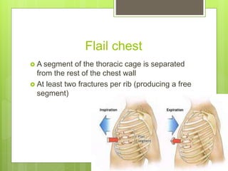 Flail Rips Thoracic surgeries | PPTX