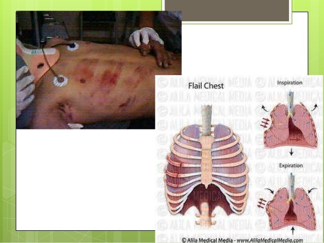 Thoracic surgeries