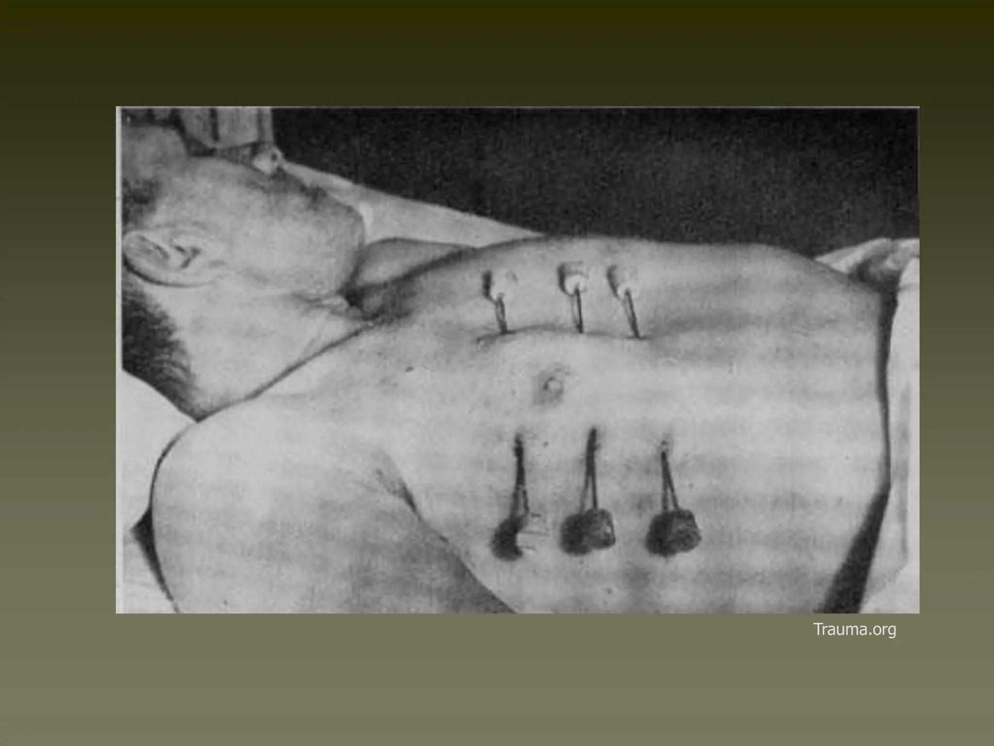 thoracic trauma all types of management.ppt