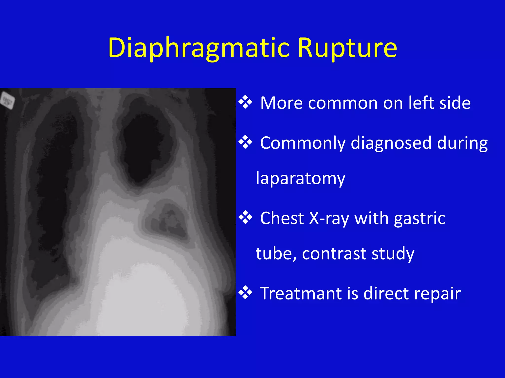 Thoracic trauma and pain management | PPTX