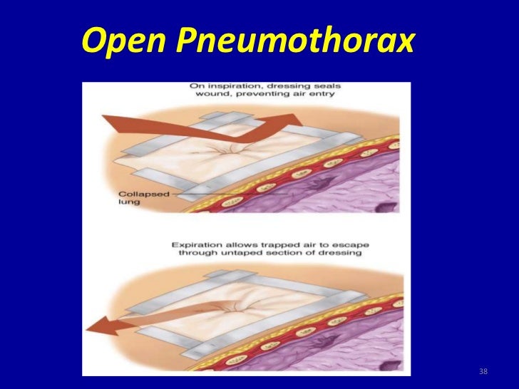 pneumothorax home treatment