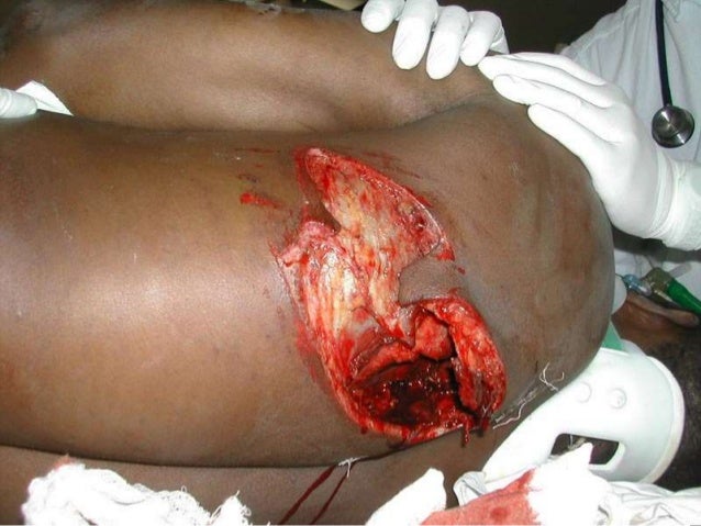 Breathing In Glass In Car Accident Breathing In Glass In Car Accident