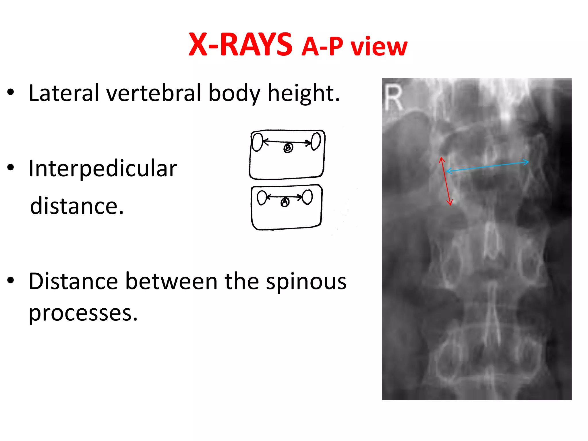 Thoraco lumbar fractures | PPTX