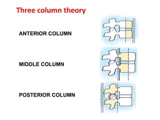 Three column theory
ANTERIOR COLUMN
MIDDLE COLUMN
POSTERIOR COLUMN
 