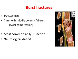 Burst fractures
• 15 % of TL#s
• Anterior& middle column failure.
(Axial compression)
• Most common at T/L junction
• Neurological deficit.
 