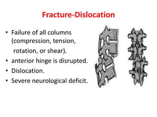 Fracture-Dislocation
• Failure of all columns
(compression, tension,
rotation, or shear).
• anterior hinge is disrupted.
• Dislocation.
• Severe neurological deficit.
 
