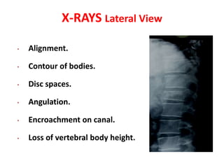 X-RAYS Lateral View
• Alignment.
• Contour of bodies.
• Disc spaces.
• Angulation.
• Encroachment on canal.
• Loss of vertebral body height.
 