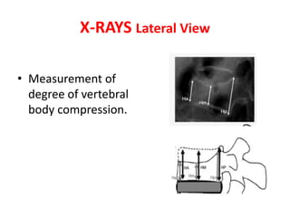 X-RAYS Lateral View
• Measurement of
degree of vertebral
body compression.
 