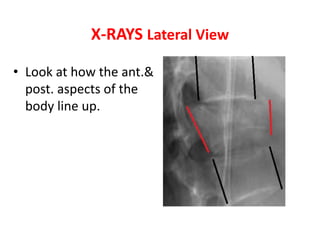 • Look at how the ant.&
post. aspects of the
body line up.
X-RAYS Lateral View
 