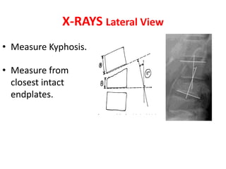 X-RAYS Lateral View
• Measure Kyphosis.
• Measure from
closest intact
endplates.
 