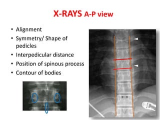• Alignment
• Symmetry/ Shape of
pedicles
• Interpedicular distance
• Position of spinous process
• Contour of bodies
X-RAYS A-P view
 