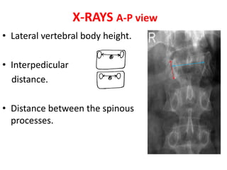 X-RAYS A-P view
• Lateral vertebral body height.
• Interpedicular
distance.
• Distance between the spinous
processes.
 