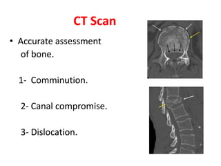 CT Scan
• Accurate assessment
of bone.
1- Comminution.
2- Canal compromise.
3- Dislocation.
 