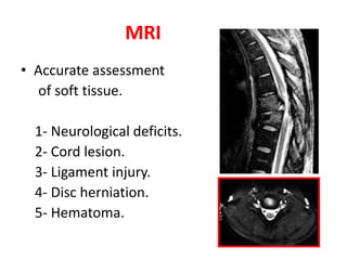 MRI
• Accurate assessment
of soft tissue.
1- Neurological deficits.
2- Cord lesion.
3- Ligament injury.
4- Disc herniation.
5- Hematoma.
 