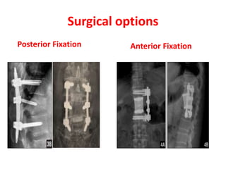 Surgical options
Anterior FixationPosterior Fixation
 