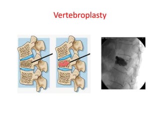 Vertebroplasty
 