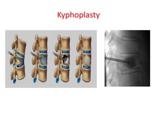 Kyphoplasty
 