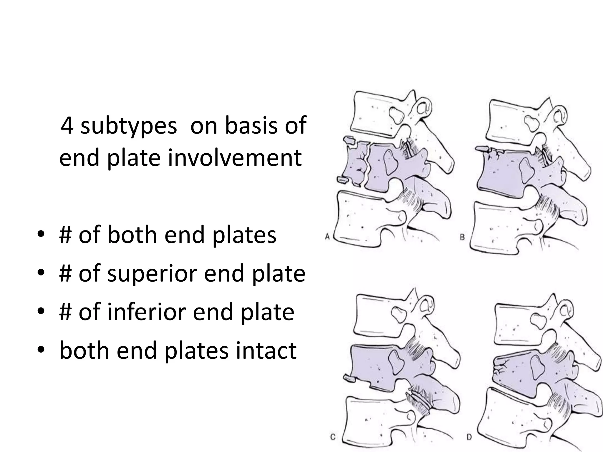 T7 Compression Thoraco lumbar fractures of spine | PPTX