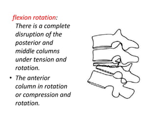 Thoraco lumbar fractures of spine | PPTX