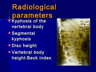 RRaaddiioollooggiiccaall 
ppaarraammeetteerrss 
KKyypphhoossiiss ooff tthhee 
vveerrtteebbrraall bbooddyy 
SSeeggmmeennttaall 
kkyypphhoossiiss 
DDiisscc hheeiigghhtt 
VVeerrtteebbrraall bbooddyy 
hheeiigghhtt::BBeecckk iinnddeexx 
 