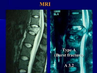 MRI 
TTyyppee AA 
((BBuurrsstt ffrraaccttuurree)) 
AA 33..22 
 