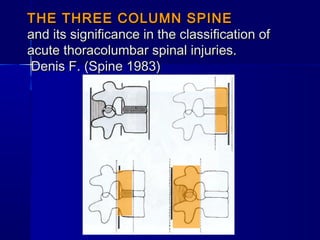 THE TTHHRREEEE CCOOLLUUMMNN SSPPIINNEE 
aanndd iittss ssiiggnniiffiiccaannccee iinn tthhee ccllaassssiiffiiccaattiioonn ooff 
aaccuuttee tthhoorraaccoolluummbbaarr ssppiinnaall iinnjjuurriieess.. 
DDeenniiss FF.. ((SSppiinnee 11998833)) 
 