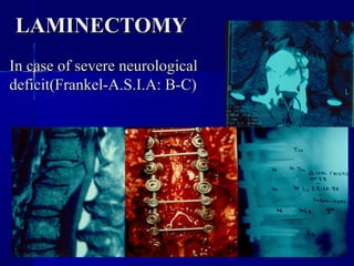 LLAAMMIINNEECCTTOOMMYY 
IInn ccaassee ooff sseevveerree nneeuurroollooggiiccaall 
ddeeffiicciitt((FFrraannkkeell--AA..SS..II..AA:: BB--CC)) 
 