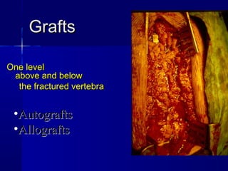 GGrraaffttss 
OOnnee lleevveell 
aabboovvee aanndd bbeellooww 
tthhee ffrraaccttuurreedd vveerrtteebbrraa 
•AAuuttooggrraaffttss 
•AAllllooggrraaffttss 
 