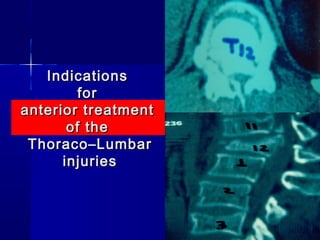 IInnddiiccaattiioonnss 
ffoorr 
aanntteerriioorr ttrreeaattmmeenntt 
ooff tthhee 
TThhoorraaccoo––LLuummbbaarr 
iinnjjuurriieess 
 