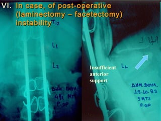 VVII.. IInn ccaassee,, ooff ppoosstt--ooppeerraattiivvee 
((llaammiinneeccttoommyy –– ffaacceetteeccttoommyy)) 
iinnssttaabbiilliittyy 
Insufficient 
anterior 
support 
 