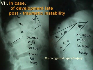 Misrecognized type of injury 
VVIIII.. IInn ccaassee,, 
ooff ddeevveellooppmmeenntt llaattee 
ppoosstt -- ttrraauummaattiicc iinnssttaabbiilliittyy 
 