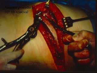Anterior procedure 
10th rib removal 
 
