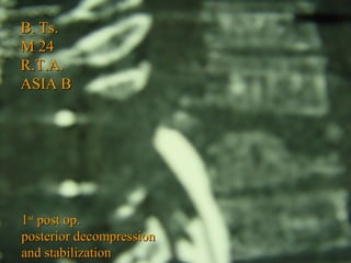 BB.. TTss.. 
MM 2244 
RR..TT..AA.. 
AASSIIAA BB 
11sstt ppoosstt oopp.. 
ppoosstteerriioorr ddeeccoommpprreessssiioonn 
aanndd ssttaabbiilliizzaattiioonn 
 