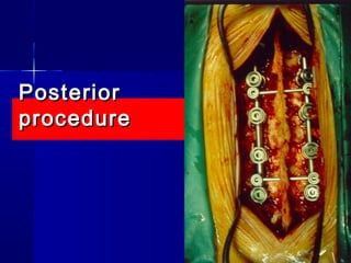 PPoosstteerriioorr 
pprroocceedduurree 
 