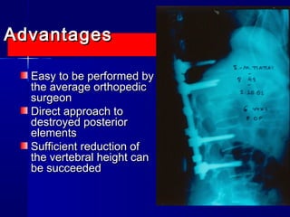 AAddvvaannttaaggeess 
EEaassyy ttoo bbee ppeerrffoorrmmeedd bbyy 
tthhee aavveerraaggee oorrtthhooppeeddiicc 
ssuurrggeeoonn 
DDiirreecctt aapppprrooaacchh ttoo 
ddeessttrrooyyeedd ppoosstteerriioorr 
eelleemmeennttss 
SSuuffffiicciieenntt rreedduuccttiioonn ooff 
tthhee vveerrtteebbrraall hheeiigghhtt ccaann 
bbee ssuucccceeeeddeedd 
 