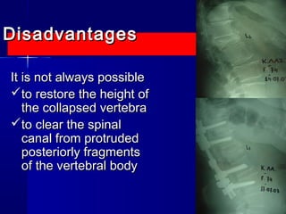 DDiissaaddvvaannttaaggeess 
IItt iiss nnoott aallwwaayyss ppoossssiibbllee 
ttoo rreessttoorree tthhee hheeiigghhtt ooff 
tthhee ccoollllaappsseedd vveerrtteebbrraa 
ttoo cclleeaarr tthhee ssppiinnaall 
ccaannaall ffrroomm pprroottrruuddeedd 
ppoosstteerriioorrllyy ffrraaggmmeennttss 
ooff tthhee vveerrtteebbrraall bbooddyy 
 