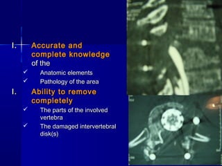 II.. AAccccuurraattee aanndd 
ccoommpplleettee kknnoowwlleeddggee 
ooff tthhee 
 AAnnaattoommiicc eelleemmeennttss 
 PPaatthhoollooggyy ooff tthhee aarreeaa 
II.. AAbbiilliittyy ttoo rreemmoovvee 
ccoommpplleetteellyy 
 TThhee ppaarrttss ooff tthhee iinnvvoollvveedd 
vveerrtteebbrraa 
 TThhee ddaammaaggeedd iinntteerrvveerrtteebbrraall 
ddiisskk((ss)) 
 