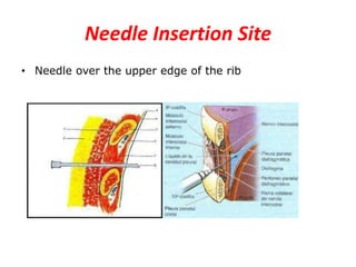 Needle Insertion Site
• Needle over the upper edge of the rib
 