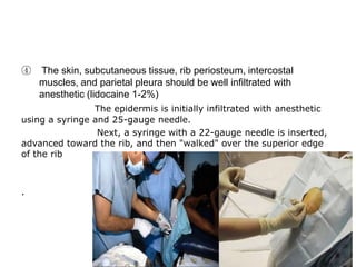 ④ The skin, subcutaneous tissue, rib periosteum, intercostal
muscles, and parietal pleura should be well infiltrated with
anesthetic (lidocaine 1-2%)
The epidermis is initially infiltrated with anesthetic
using a syringe and 25-gauge needle.
Next, a syringe with a 22-gauge needle is inserted,
advanced toward the rib, and then "walked" over the superior edge
of the rib
.
 