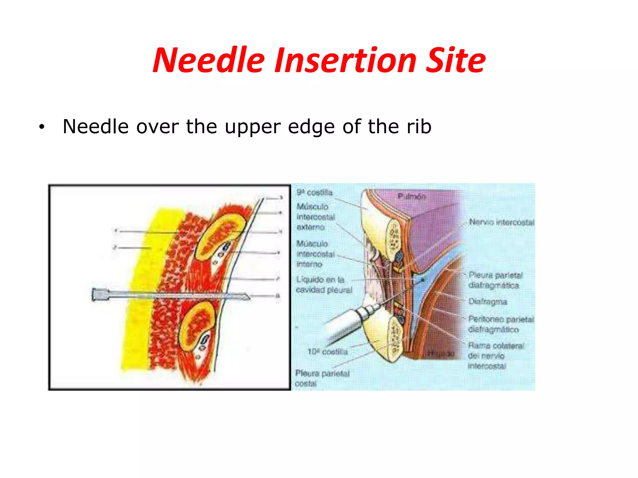 Needle Insertion Site
• Needle over the upper edge of the rib

 