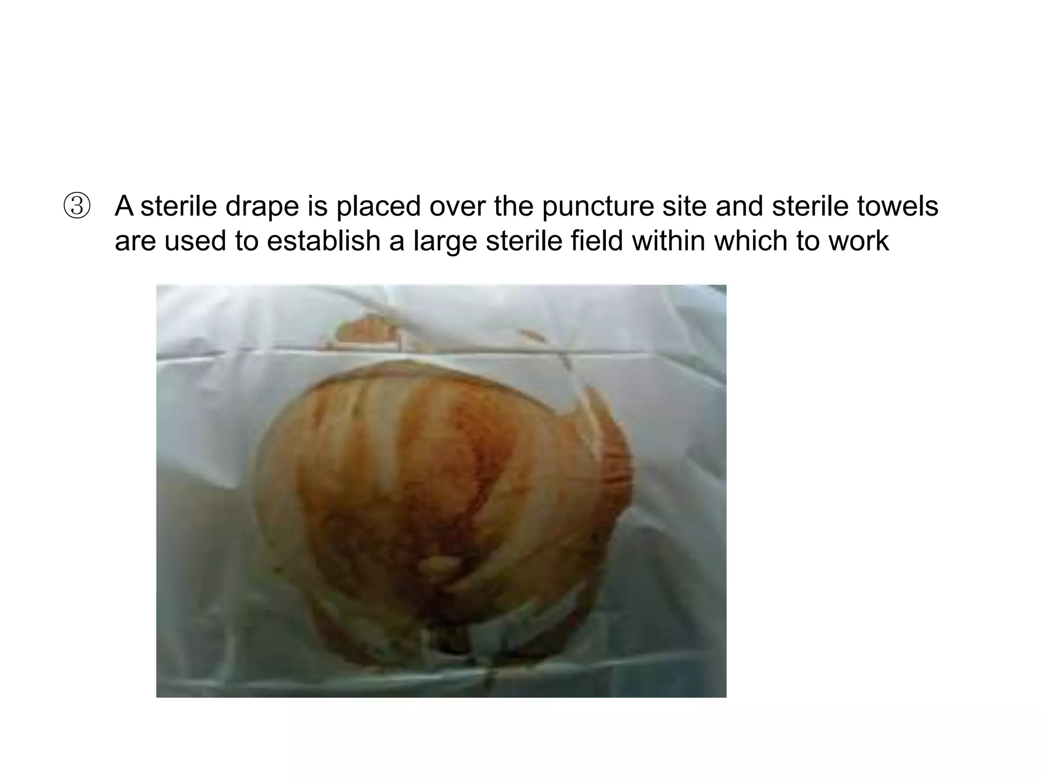 ③ A sterile drape is placed over the puncture site and sterile towels
are used to establish a large sterile field within which to work

 