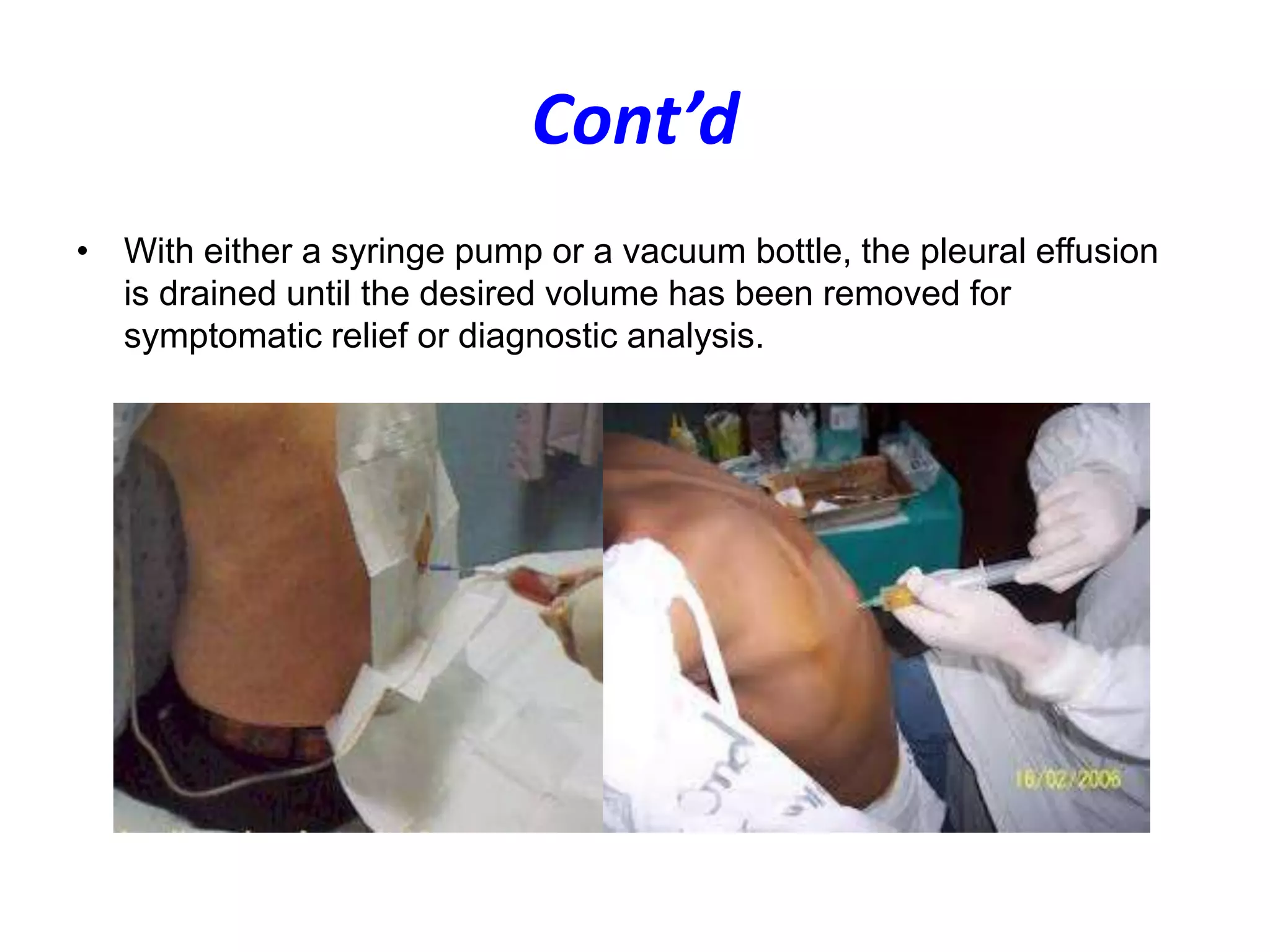 Cont’d
• With either a syringe pump or a vacuum bottle, the pleural effusion
is drained until the desired volume has been removed for
symptomatic relief or diagnostic analysis.

 