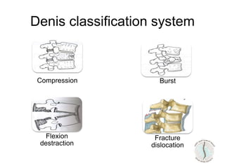 Denis classification system
Compression
Fracture
dislocation
Burst
Flexion
destraction
 