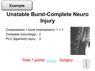 Compression + burst (mechanism): 1 + 1
Complete (neurology) : 2
PLC (ligament) injury : 3
Unstable Burst-Complete Neuro
Injury
Total 7 points Surgery
Example
 