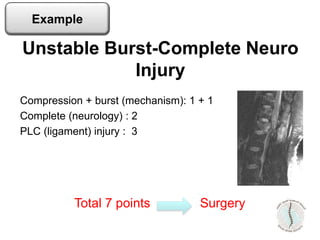 Compression + burst (mechanism): 1 + 1
Complete (neurology) : 2
PLC (ligament) injury : 3
Unstable Burst-Complete Neuro
Injury
Total 7 points Surgery
Example
 