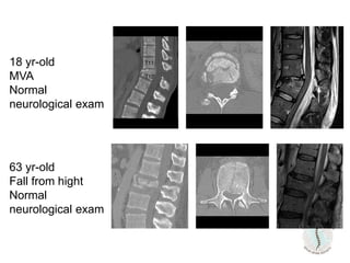 18 yr-old
MVA
Normal
neurological exam
63 yr-old
Fall from hight
Normal
neurological exam
 