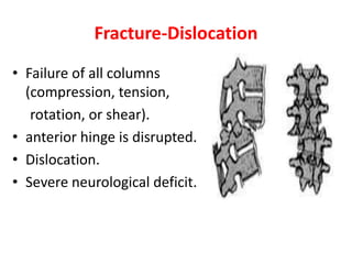 Thoracolumbar fracture for mbbs | PPTX