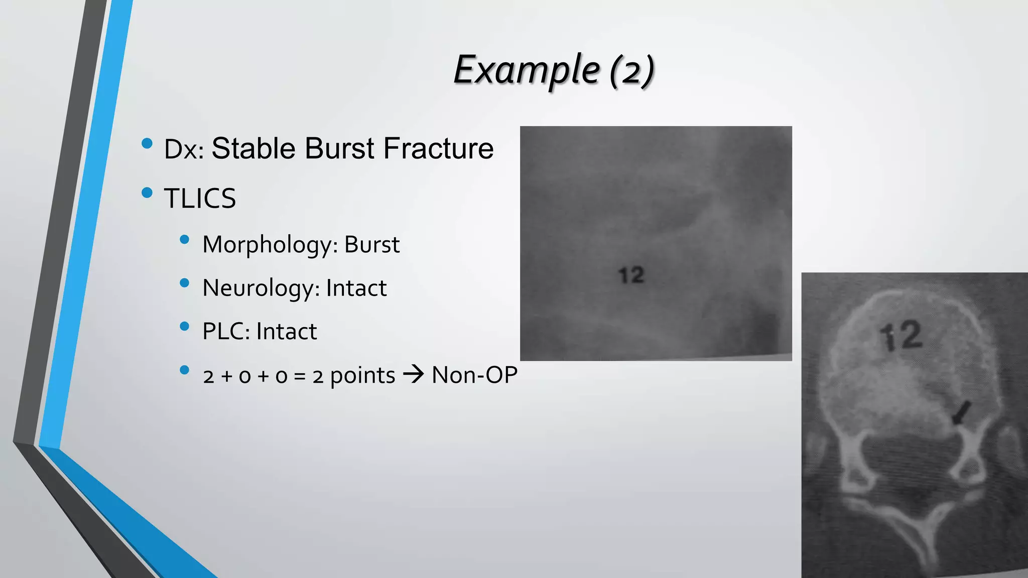 Example (2)
• Dx: Stable Burst Fracture
• TLICS
• Morphology: Burst
• Neurology: Intact
• PLC: Intact
• 2 + 0 + 0 = 2 points  Non-OP
 