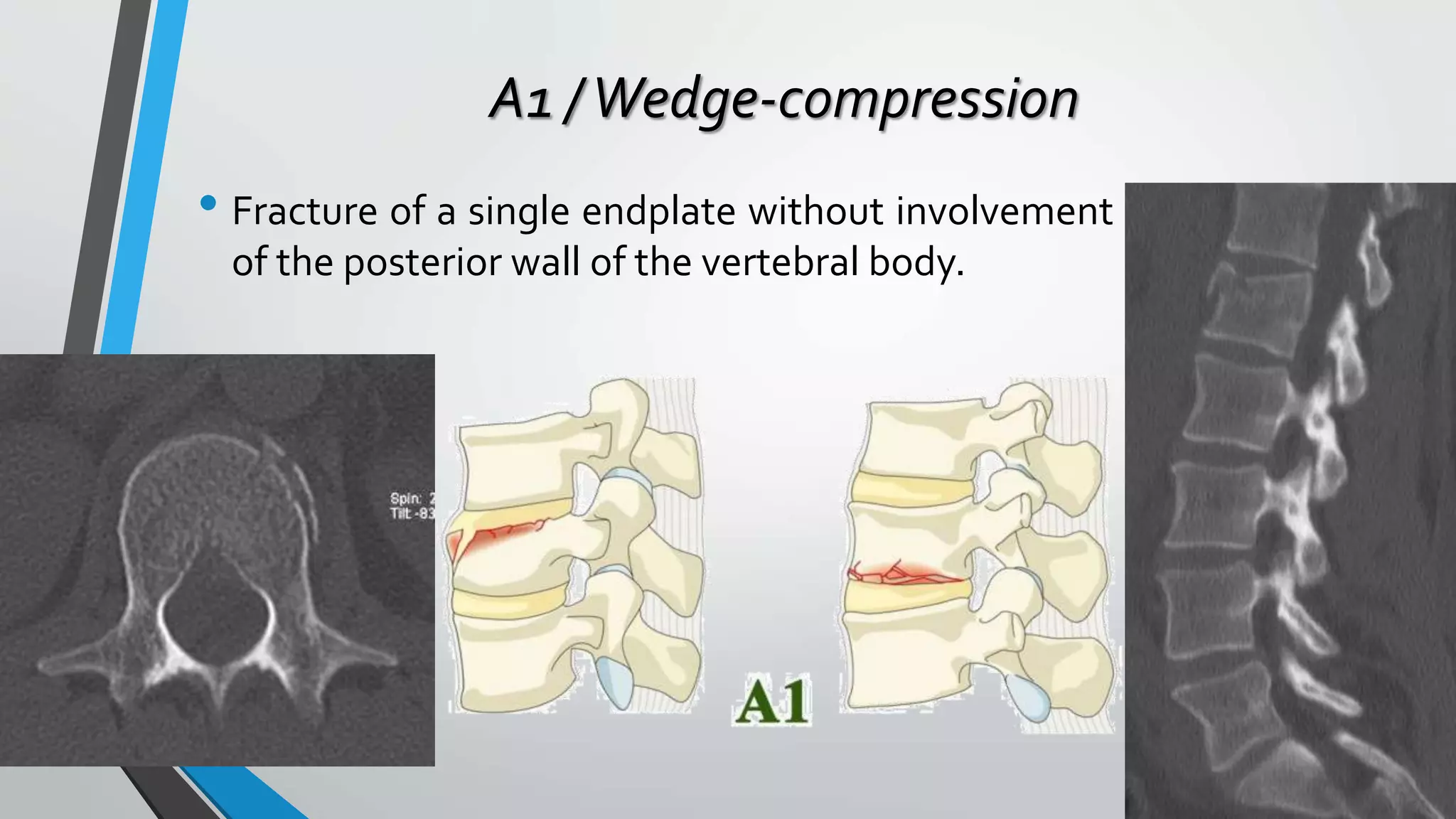 A1 /Wedge-compression
• Fracture of a single endplate without involvement
of the posterior wall of the vertebral body.
 