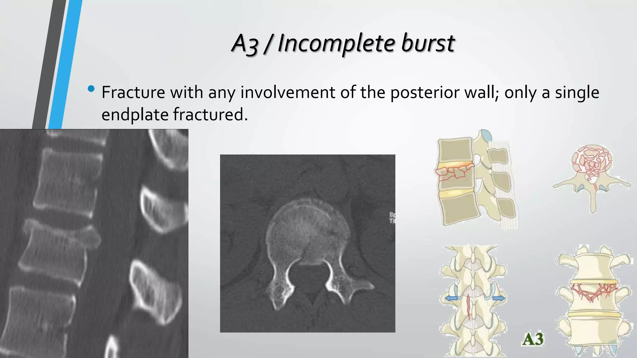 A3 / Incomplete burst
• Fracture with any involvement of the posterior wall; only a single
endplate fractured.
 